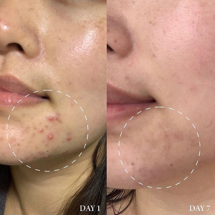 سرم ضدلک AXIS-Y دارک اسپات | روشنکننده قوی و از بینبرنده جای جوش